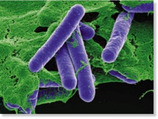 botulism